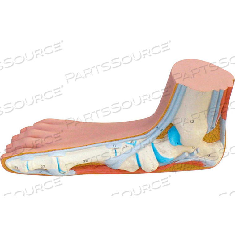 ANATOMICAL MODEL: FLAT FOOT (PES PLANUS) by Fabrication Enterprises